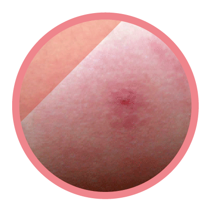 膿痂疹 (皮膚細菌感染)